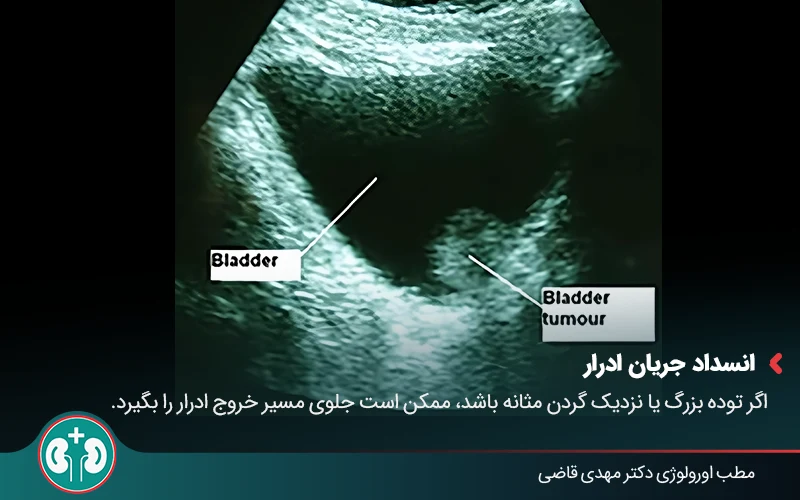 Benign Bladder Tumor 03