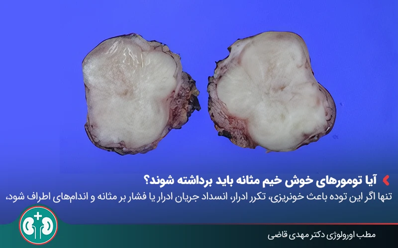Benign Bladder Tumor 06