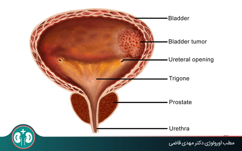 Benign Bladder Tumor