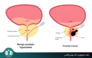 benign prostatic hyperplasia malignancy risk 01