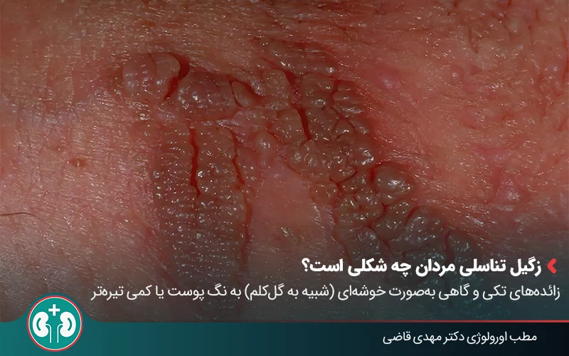 عکس زگیل تناسلی مردان