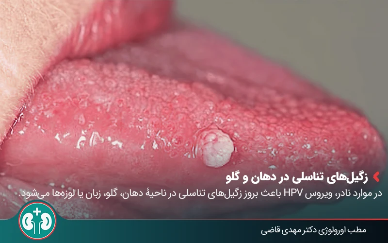 زگیل تناسلی در دهان و گلو