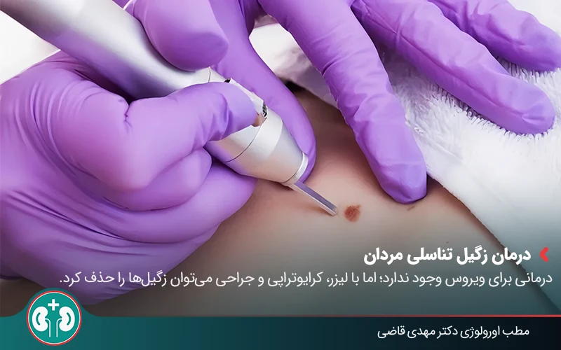 درمان زگیل تناسلی مردان با لیزر