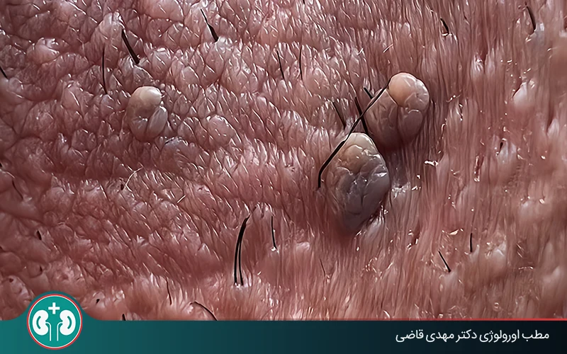 genital warts symptoms men