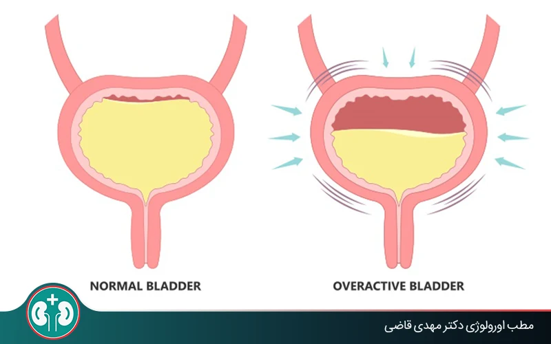 herbal remedies overactive bladder