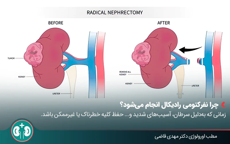 nephrectomy 02