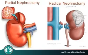 nephrectomy