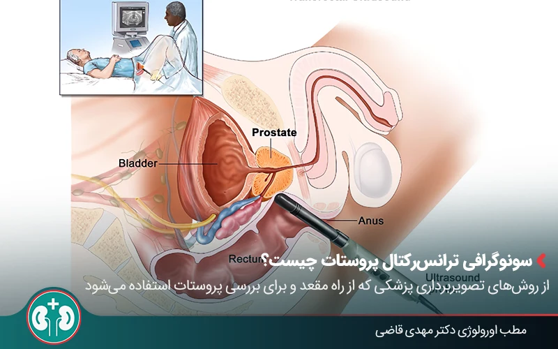 transrectal ultrasound prostate 01