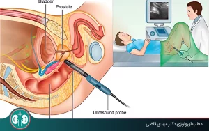 transrectal ultrasound prostate