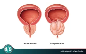 مقایسۀ اندازۀ طبیعی پروستات و پروستات بزرگ‌شده