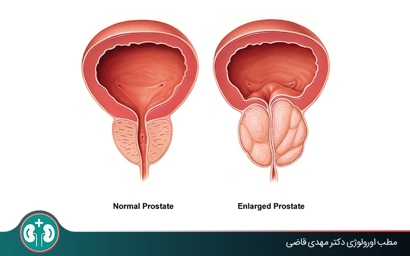 مقایسۀ اندازۀ طبیعی پروستات و پروستات بزرگ‌شده