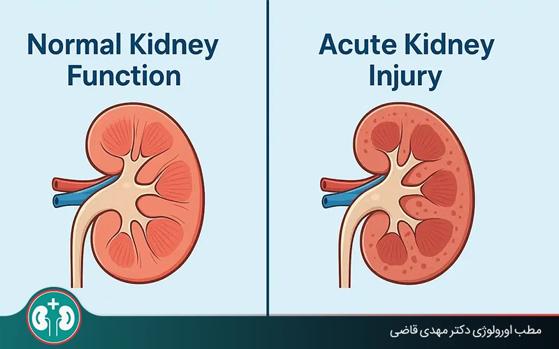 Acute Kidney Injury