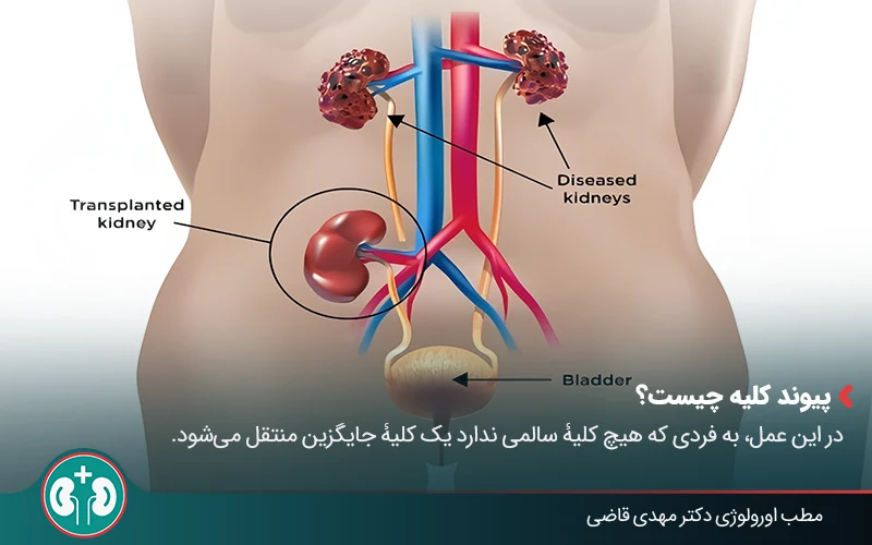 Kidney transplant 01
