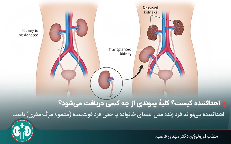 Kidney transplant 02