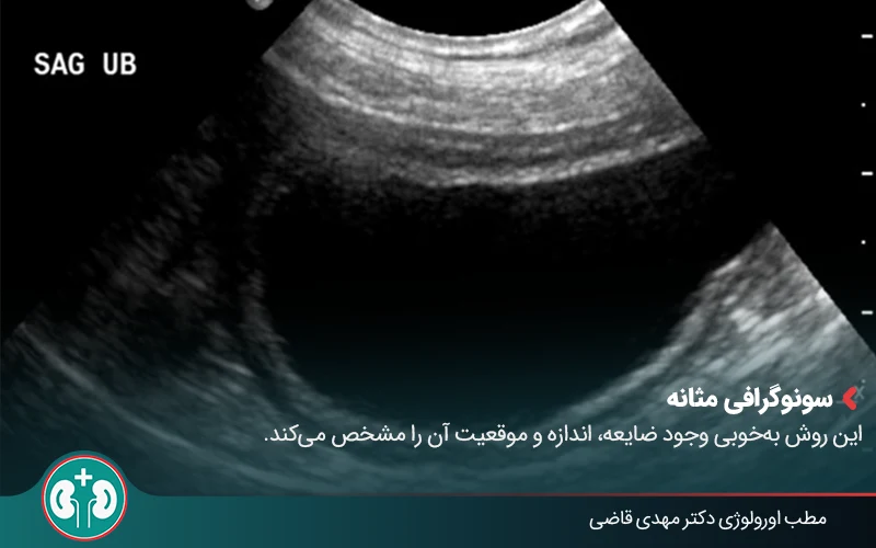 bladder cyst 03