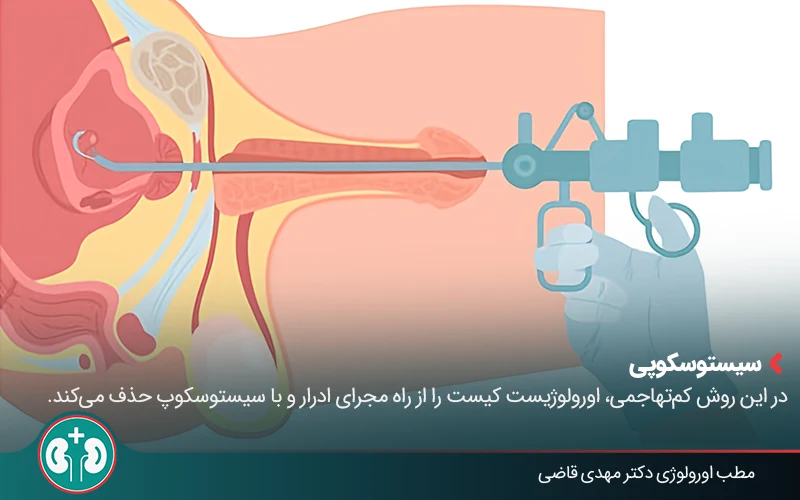 bladder cyst 04