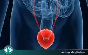 bladder cyst