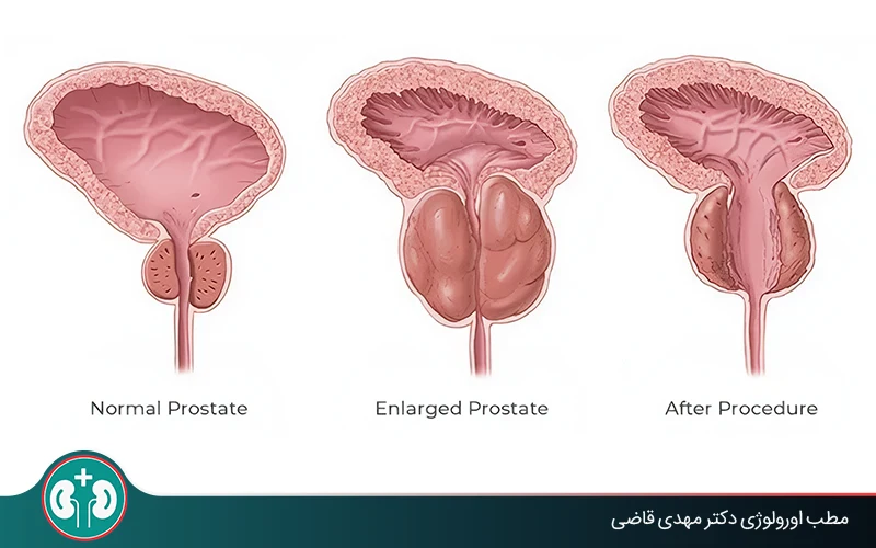 indications for prostate surgery