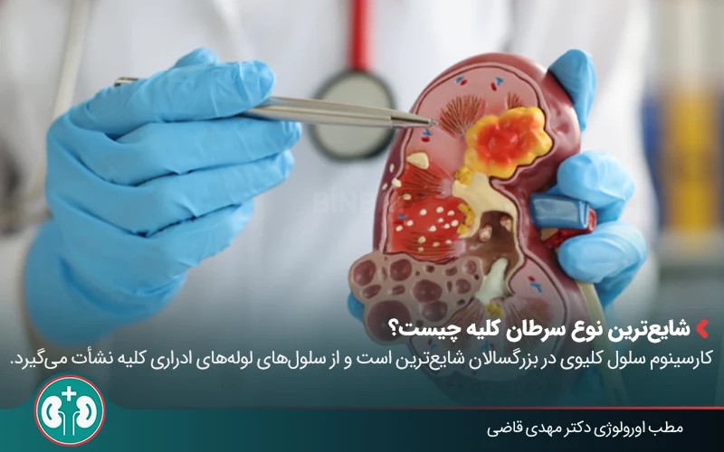 kidney cancer 01