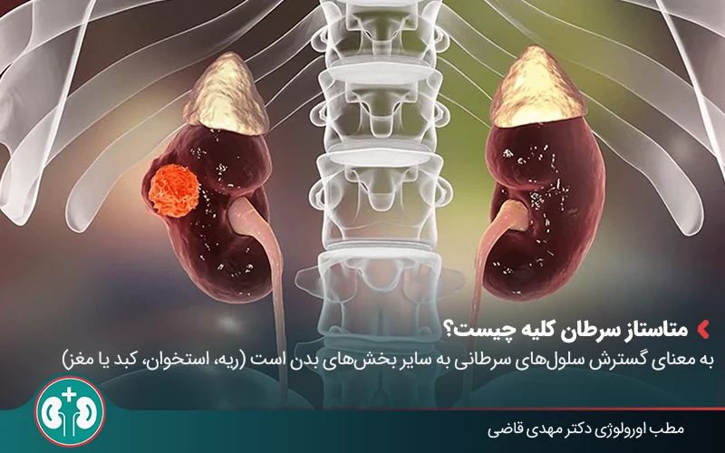 kidney cancer 02