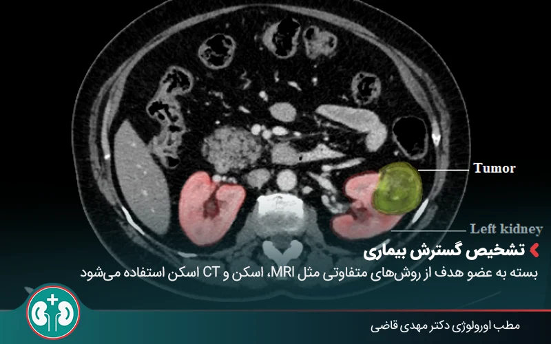 kidney cancer 05