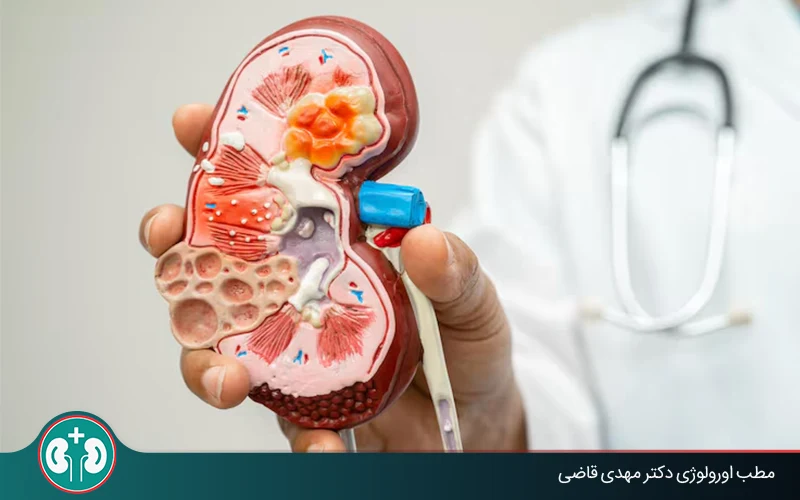 kidney cancer