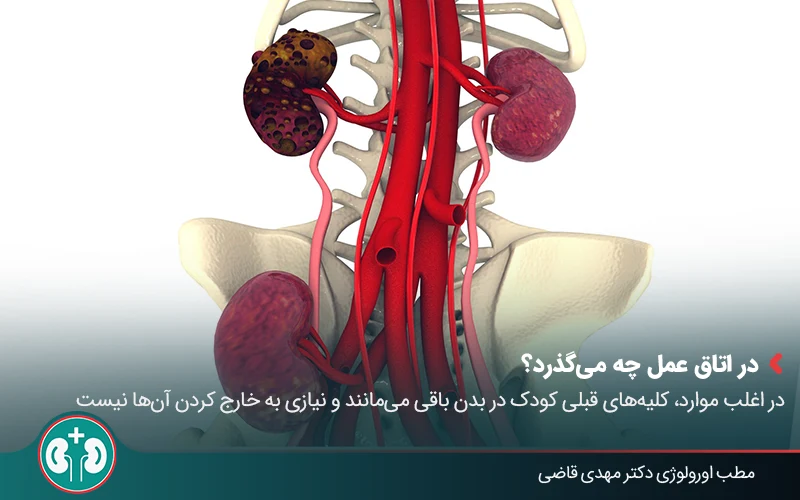 pediatric kidney transplant 05