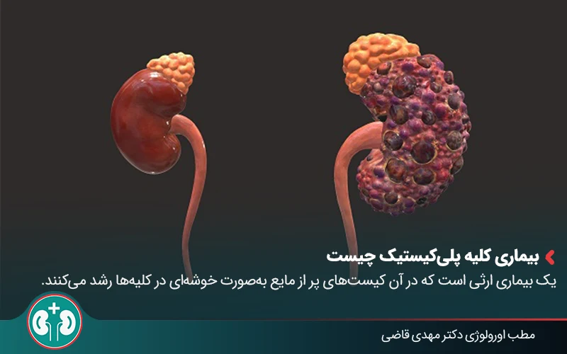polycystic kidney disease 01