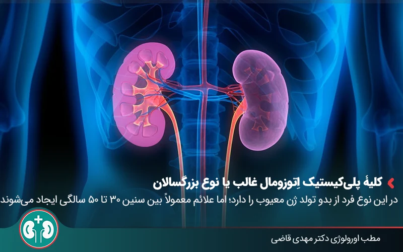 polycystic kidney disease 02