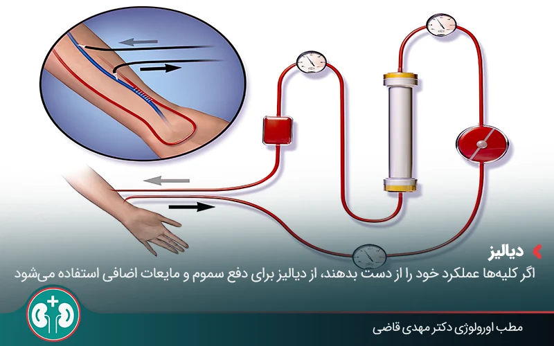polycystic kidney disease 07