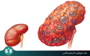 polycystic kidney disease