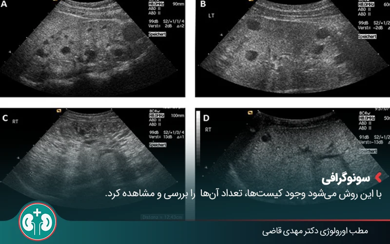 polycystic kidney disease 5