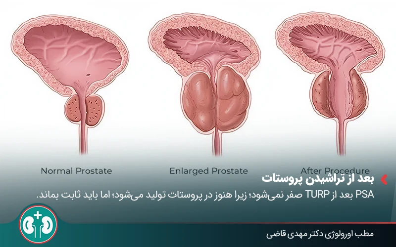 post prostatectomy psa levels 02