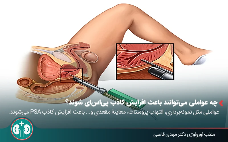 post prostatectomy psa levels 04