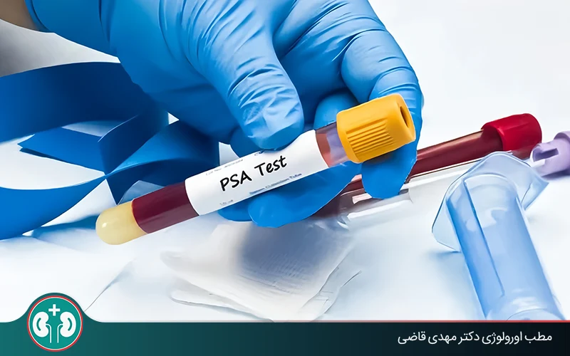 post prostatectomy psa levels