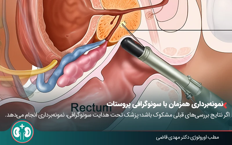 prostate ultrasound 01