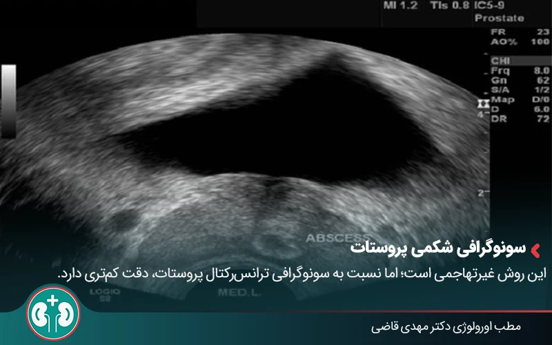 prostate ultrasound 02