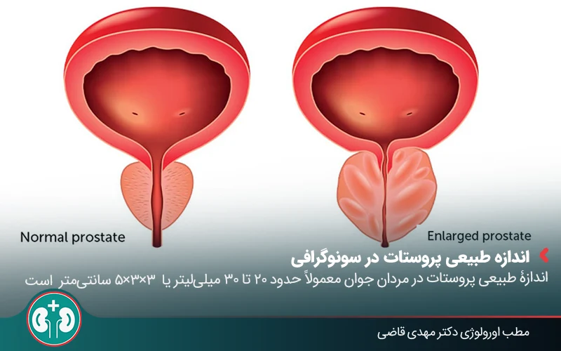 prostate ultrasound 04