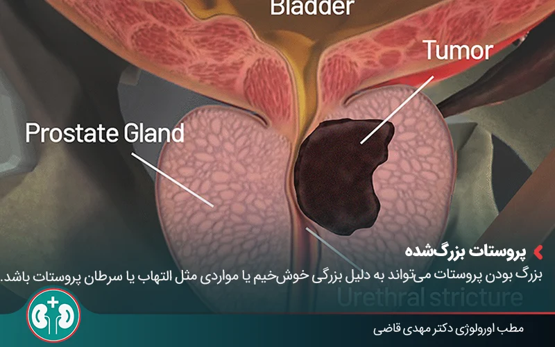 prostate ultrasound 05