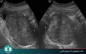prostate ultrasound