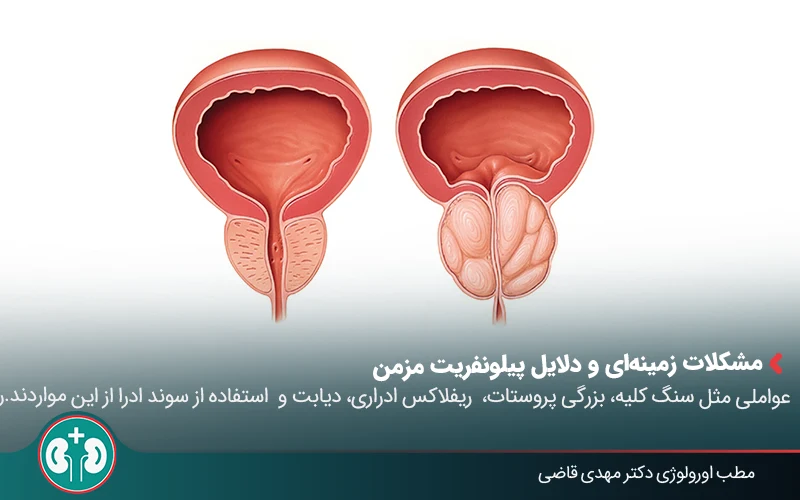 pyelonephritis 03