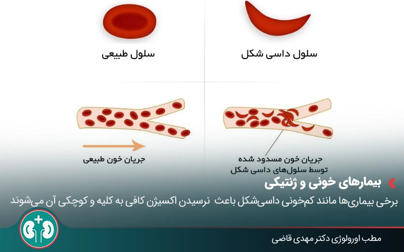 renal atrophy 04