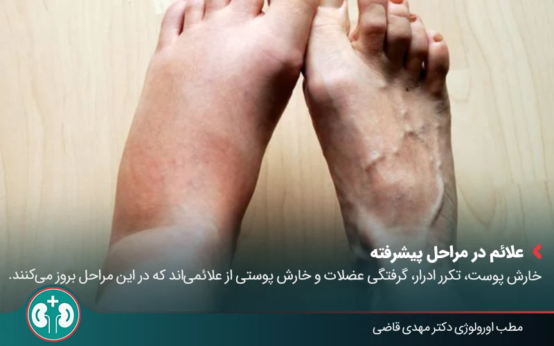 renal atrophy 07