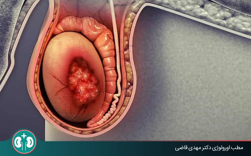 testicular mass and cancer