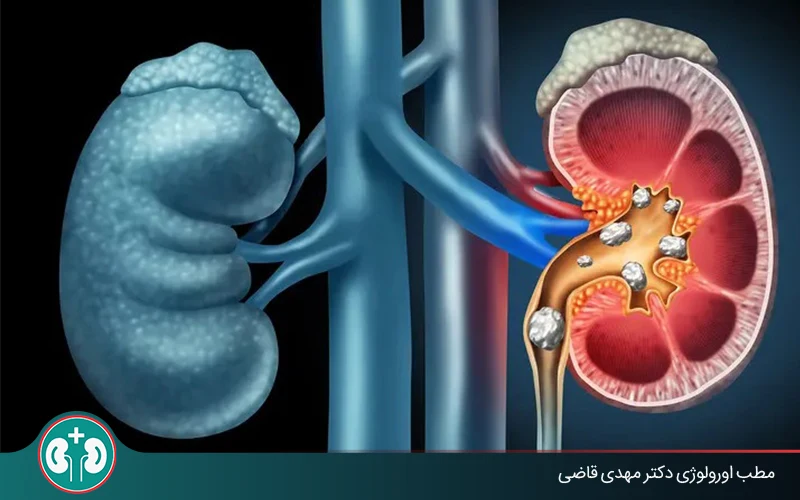 ureteral kidney stone expulsion process