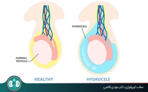 causes of one enlarged testicle