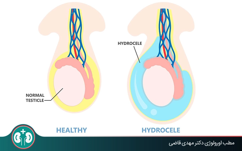 causes of one enlarged testicle